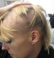 movehs - Alopecia